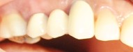 dental bridge restoration for missing teeth