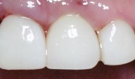 crown restoration for dental implant