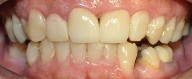 crown restoration of 2 front teeth 