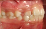 child with narrow arches, need arch development for proper tooth eruption