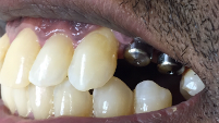 dental implants replace individual missing teeth