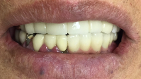 multiple dental implants' restoration